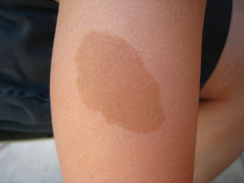 strawberry birthmarks #11