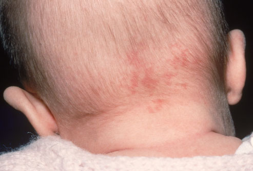 birthmarks on babies